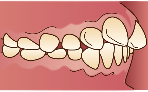 上顎前突(じょうがくぜんとつ)