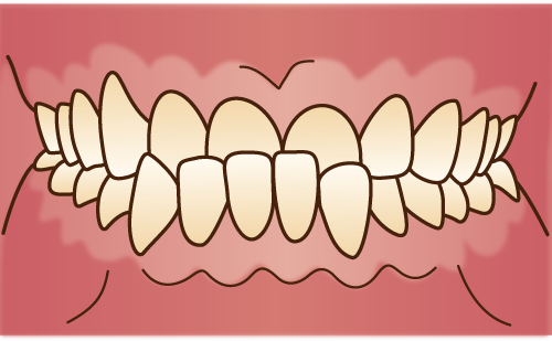 下顎前突(がかくぜんとつ)