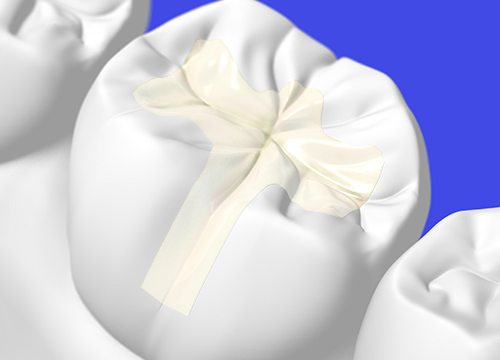 ジルコニアインレー