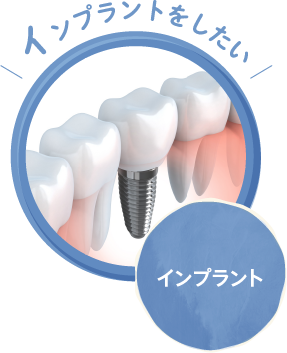 インプラント