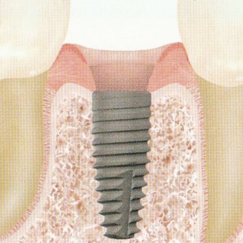 インプラント体の埋入と治癒