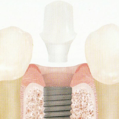 アバットメント(支台の装着)