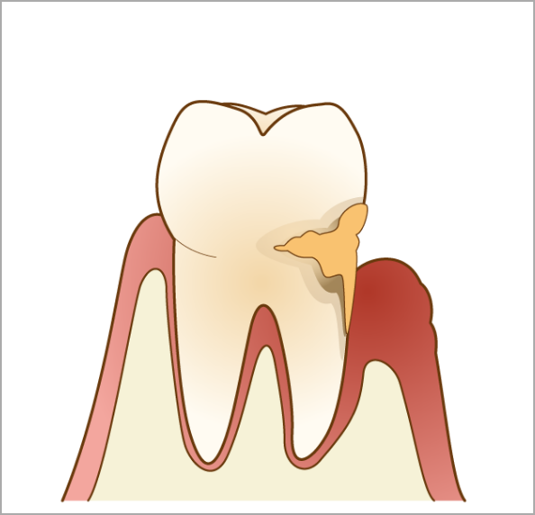歯周病の進行・原因