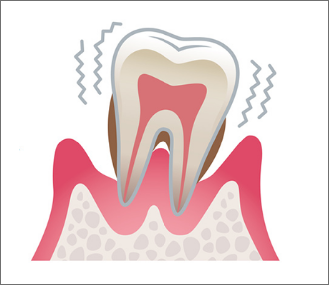 重度の歯周病
