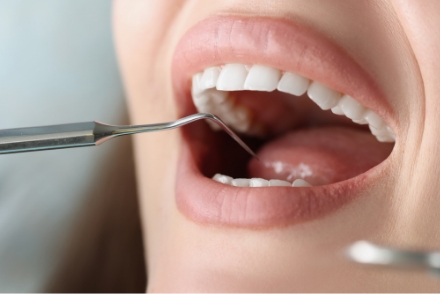 スケーリング(歯石除去)